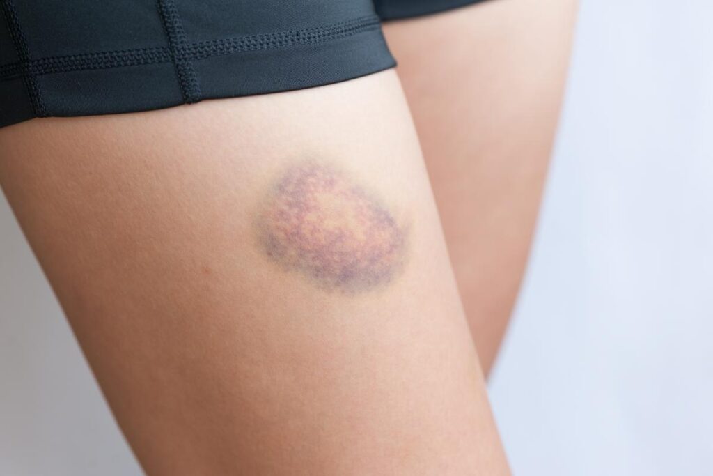 a person with a bruise on their thigh wonders to themselves about how to get rid of bruises from iv drug use